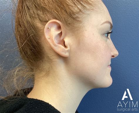 Non-Surgical Facial Liposuction | Houston, TX | Ayim Aesthetic