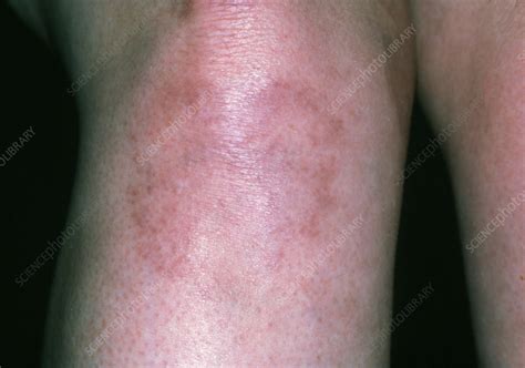 Lupus Rashes On Legs