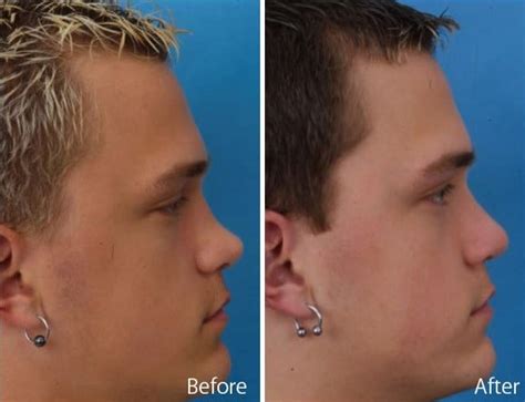 Upturned Nose Upturned Nose – Rhinoplasty Orlando Nose Job