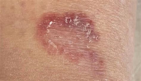 Skin Diseases Holes