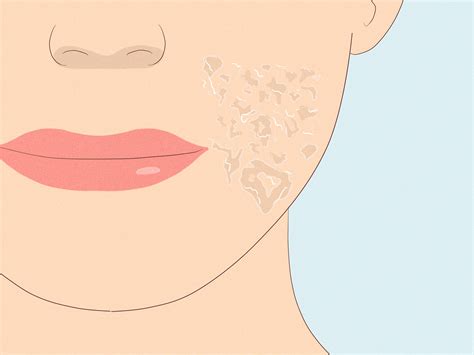 how to get tretinoin