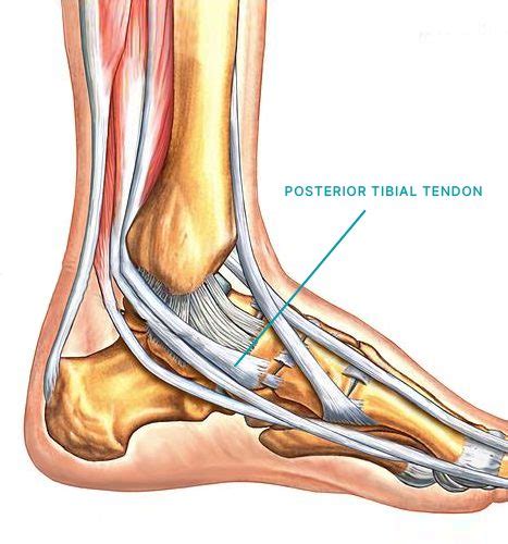 posterior tibial tendon dysfunction  foot practice sports