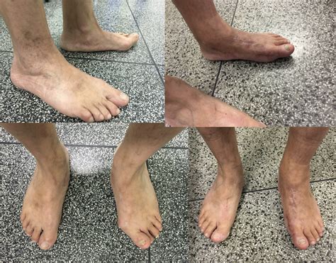 Existe Cirurgia Para Diminuir O Pé - Dr. Lucas Fonseca - Especialista em Cirurgia de Pé Chato