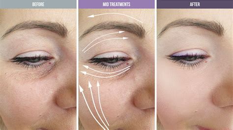 Eye Lift & Skin Lifting Treatments in Malvern, Melbourne