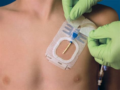 how to draw blood from a mediport