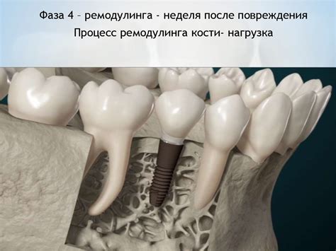 Остеопороз и имплантация - презентация онлайн