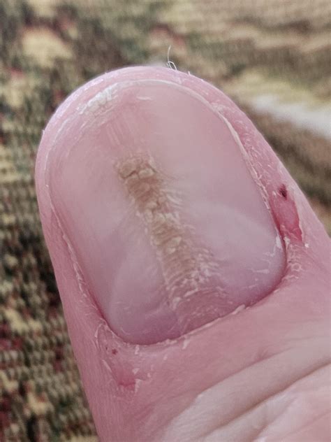 My thumb nails is wrecked, is this my psoriasis? Any advice because it