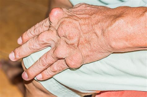 target serum urate  remission difficult  achieve  severe gout