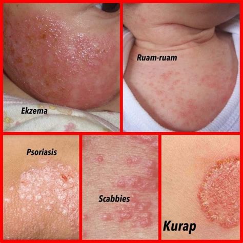 jenis jenis penyakit kulit homecare