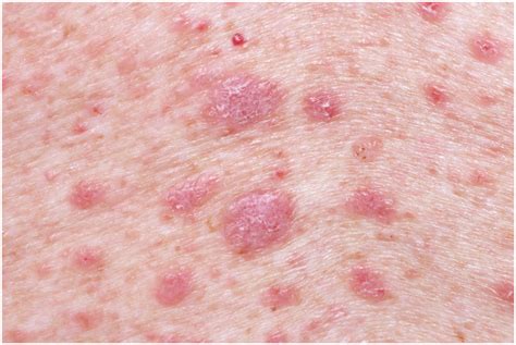 uncovering  truth  lichen planus symptoms   treatm