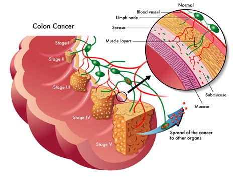 Staging Of Colon Cancer - Net Health Book