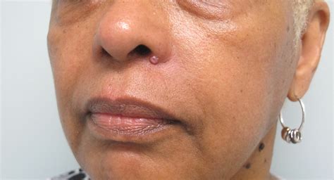 basal melanoma skin cancer vrogueco