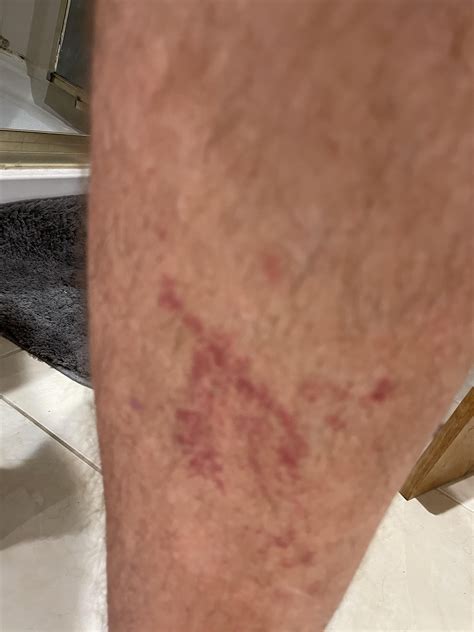 Rash on leg please help me any ideas : r/DermatologyQuestions