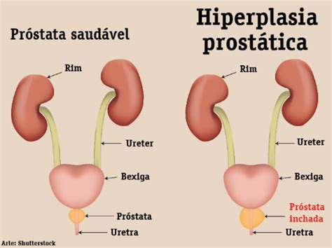 O Que É Hiperplasia Prostática Benigna