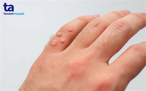 virus hpv la gi nguyen nhan dau hieu chan doan va phong ngua