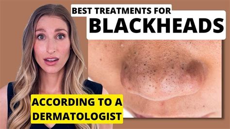 Forget Everything You Know: Unbelievable Blackhead Removal 2024 Revealed - hnpvkcy
