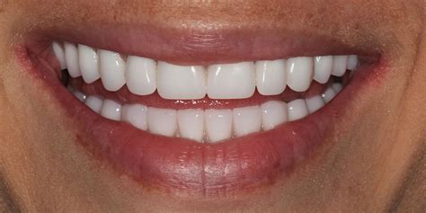All-on-4®- Downtown Dallas TX | Dallas Dental Arts