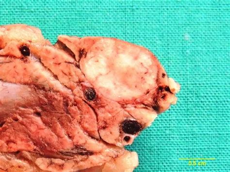 insulinoma clinical features