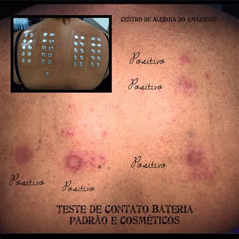 Teste De Contato Padrao E Cosmeticos - CAIAM - Centro de Alergia e Imunologia do Amazonas - Teste de Contato ...