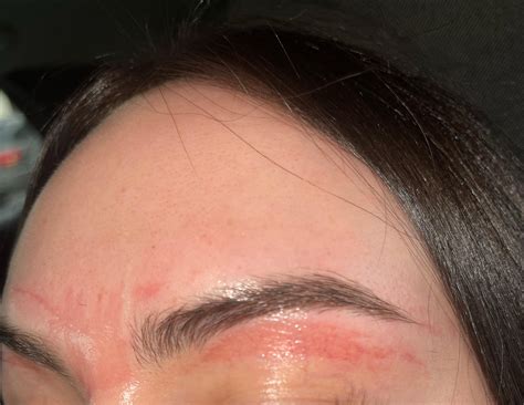 Help, my skin ripped off after getting my eyebrows waxed. I know my