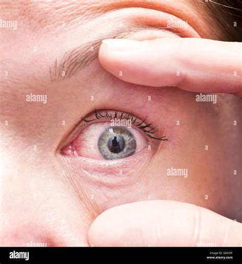 Eye pollen hi-res stock photography and images - Alamy