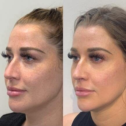 Juvederm Cheeks Before And After Photos