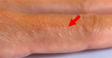 Dyshidrotic Eczema Signs, Symptoms, And Treatment : Secret Life Of Mom