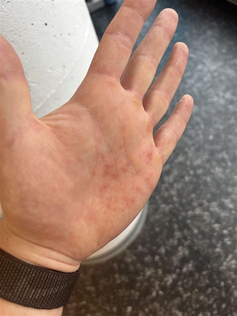 dyshidrosis eczema rdyshidrosis