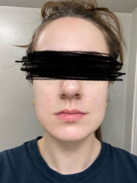 Random, unexpected breakout and irritation : r/tretinoin