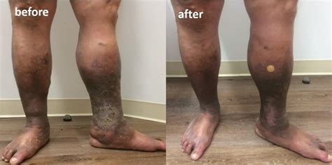 venous ulcer guide  leg wounds insufficiency