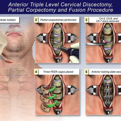 Medical Legal Exhibits - Legal Animations & Trial Graphics - Tria...