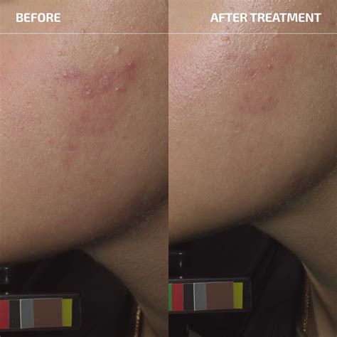 Bacterial Acne Set | Face Scrub, Tone... – Codex Labs Corp