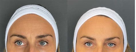 Botox Forehead Before and After: Key Botox injection points and the ...