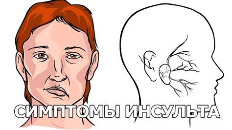 Симптомы и признаки инсульта - YouTube