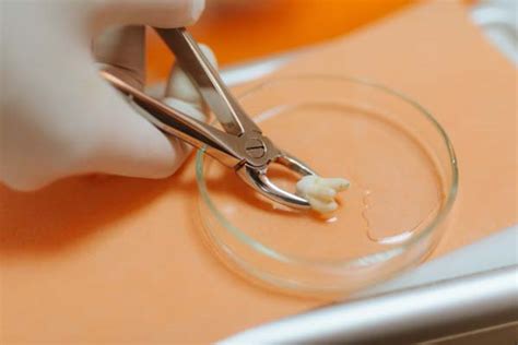 step  step guide   tooth extraction procedure pacific horizon