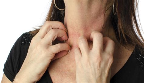 Alergia al sol: síntomas y tratamiento