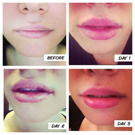 Lip Filler Swelling Stages: Here's What To Expect! | CelebrityStyleGuide