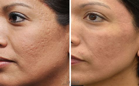 Acne Scars And Treatment at Lloyd Sutton blog