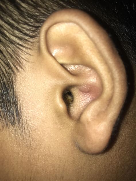 Bump On Ear After Wearing Earrings at Joel Norris blog
