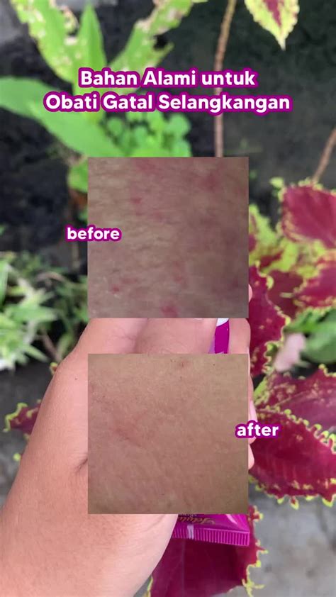 obat gatal selangkangan solusi alami  ampuh tiktok