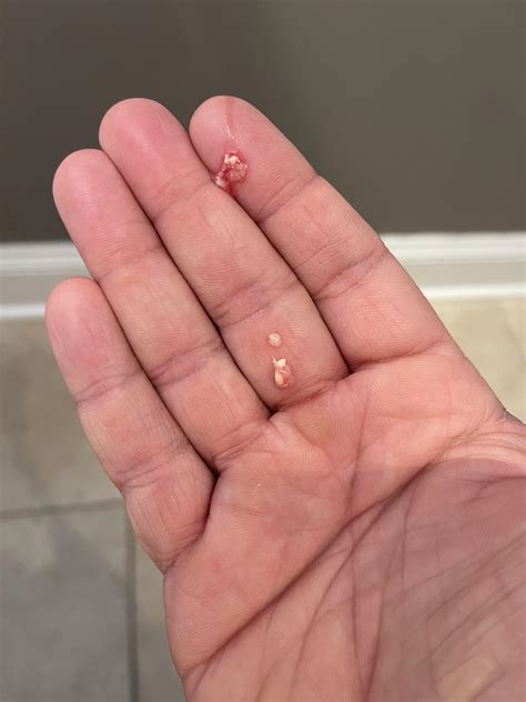 Popped a cyst on my butt crack. Sweet relief. : r/popping