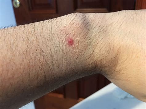 Watch sensor burns - Apple Community