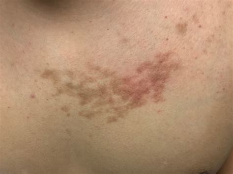 Light Brown Spots On Chest - Infoupdate.org