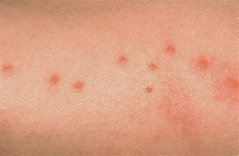 bed bugs symptoms bites pictures  treatment