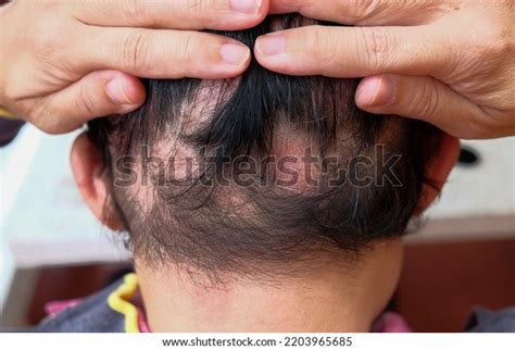 Hair Loss Type Alopecia Areata Caused Stock Photo 2203965685 | Shutterstock