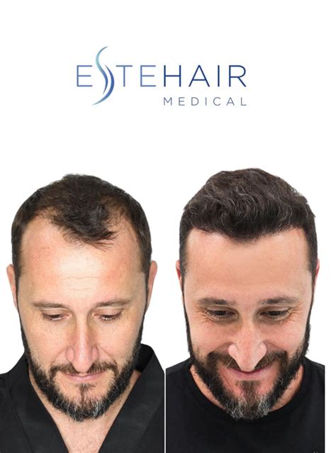 Exosome Hair Loss Treatment - Este Hair Medical