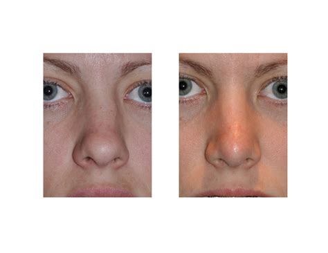 The Four Stages Of Recovery After Rhinoplasty Surgery - Explore Plastic