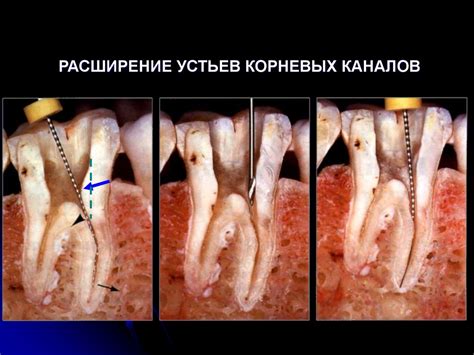Механическая обработка корневых каналов - презентация онлайн