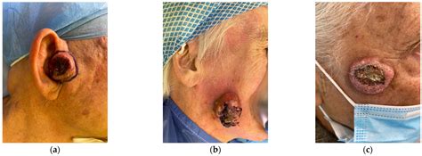 insights  pathogenesis  management  keratoacanthoma