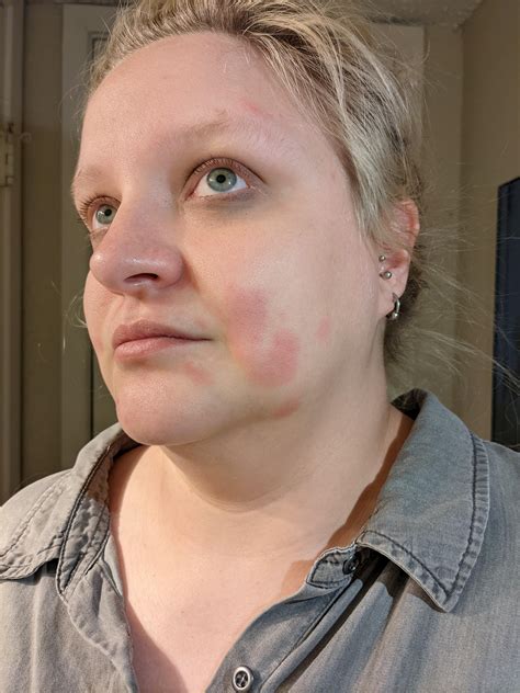[Skin Concerns] Mineral Sunscreen Reaction? : r/SkincareAddiction